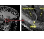 Die Grenze zwischen den wichtigen Gehirnstrukturen Hippocampus und Amygdala ist in hochaufgelösten Kernspintomografie-Bildern als feiner heller Streifen erkennbar („Amygdalo-hippocampal border“, AHB). Foto: AG Ball, Universität Freiburg 