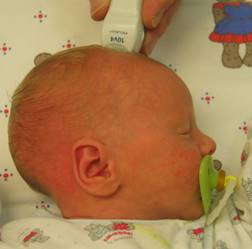 Akustisches Fenster: Um das Gehirn des Neugeborenen zu untersuchen, setzen Ärzte den Ultraschallkopf auf der großen Fontanelle des Babys auf Quelle: Prof. K.-H. Deeg, Sozialstiftung Bamberg