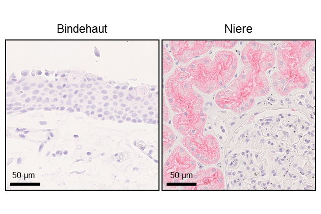  Immunhistochemische Aufnahmen zeigen vorhandene Proteine in Gewebeproben mithilfe von Antikörpern. Die Probe der Bindehautzellen (links) zeigt keine relevanten Mengen an ACE-2-Protein, während bei der Probe des Nierengewebes (rechts) Antikörper an das vorhandene ACE-2-Protein binden.
Bildquelle: Universitätsklinikum Freiburg