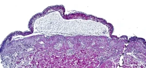 Ablösung der Epidermis bei toxischer epidermalen Nekrolyse.
© T. Nordmann 